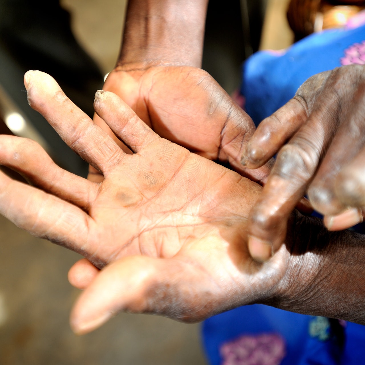 Eine Lepra-Patientin, bei der Sprechstunde in der Lepra-Klinik in Uganda