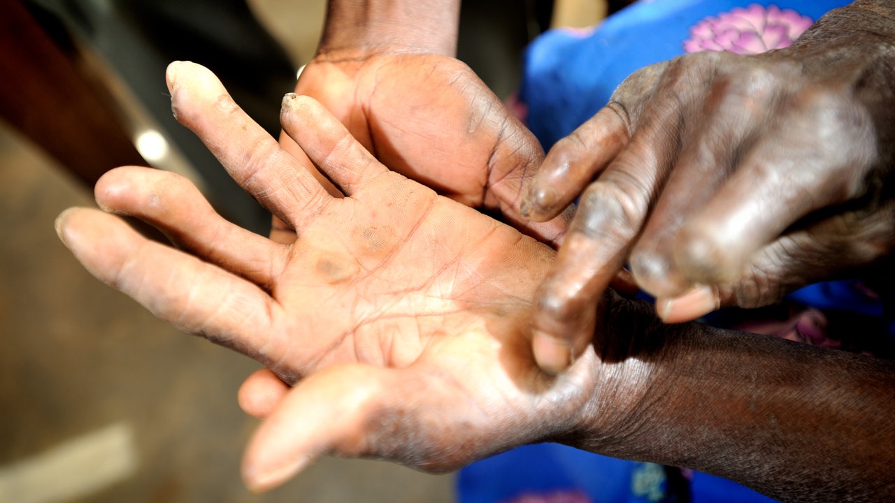 Eine Lepra-Patientin, bei der Sprechstunde in der Lepra-Klinik in Uganda